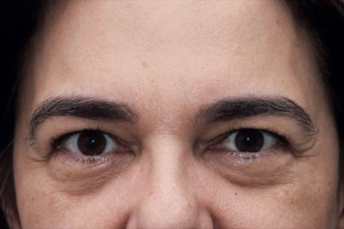 Resultado clínico de blefaroplastia