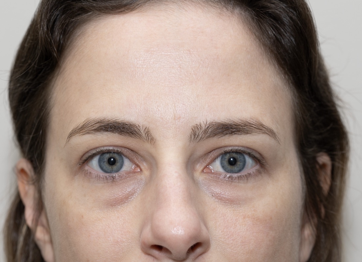 Resultado clínico de blefaroplastia transconjuntival