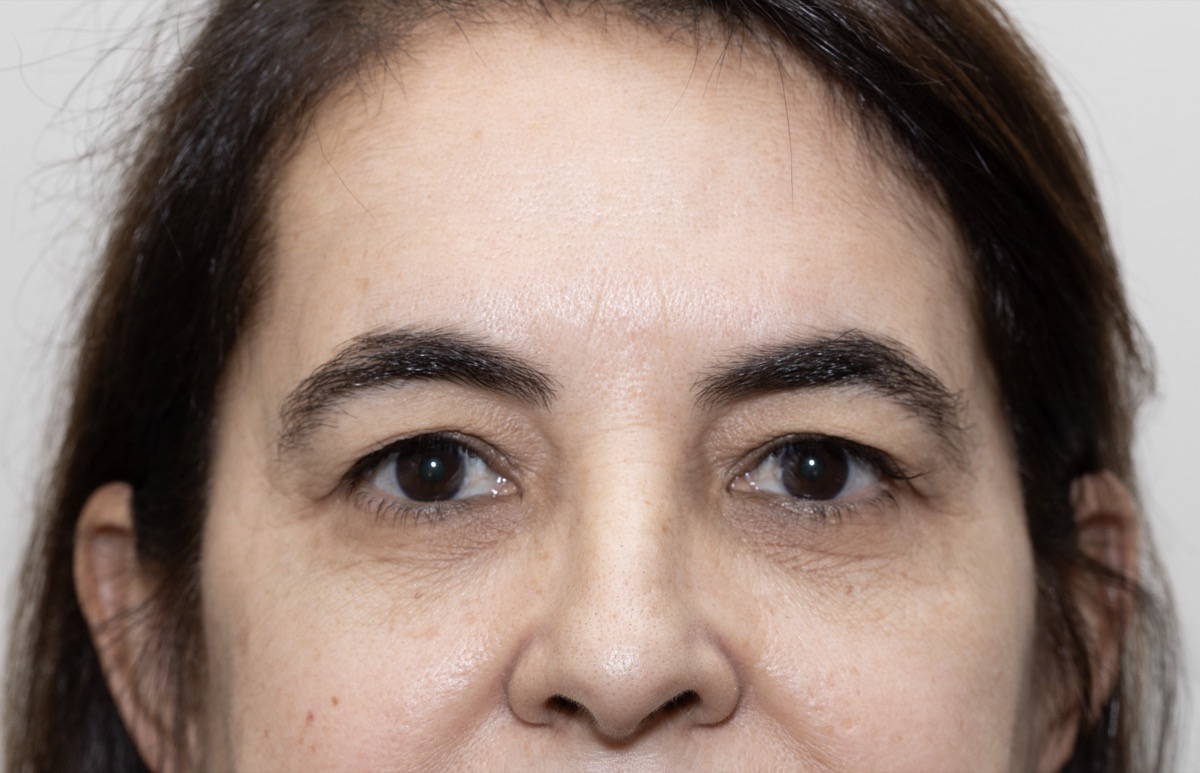 Resultado clínico de blefaroplastia e elevação de supercílio