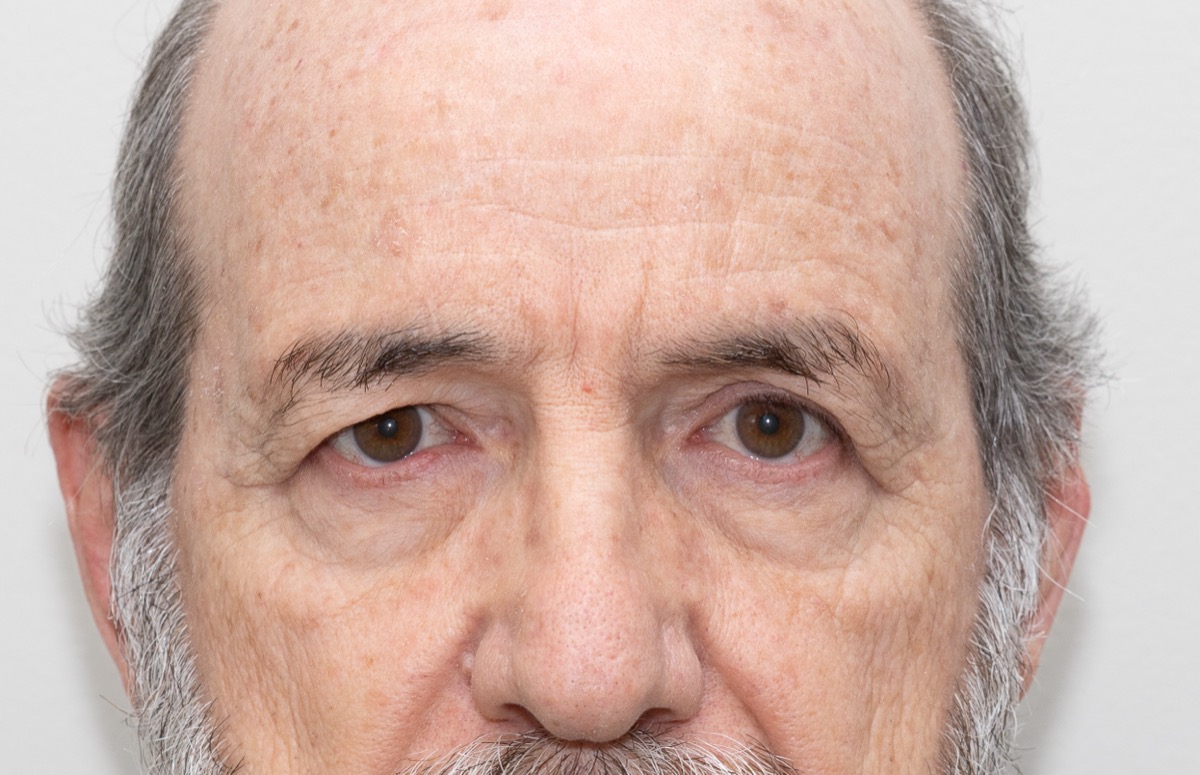 Resultado clínico de blefaroplastia masculina