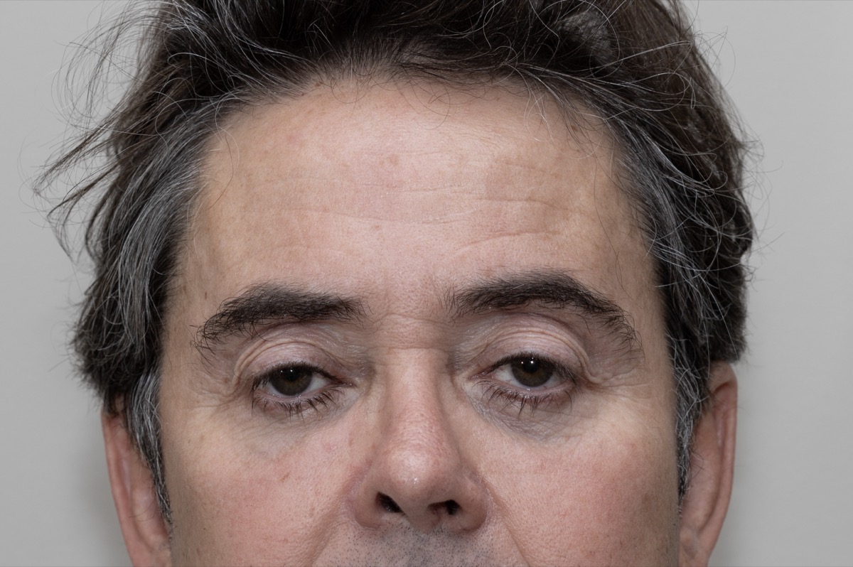 Resultado clínico de correção de ptose palpebral